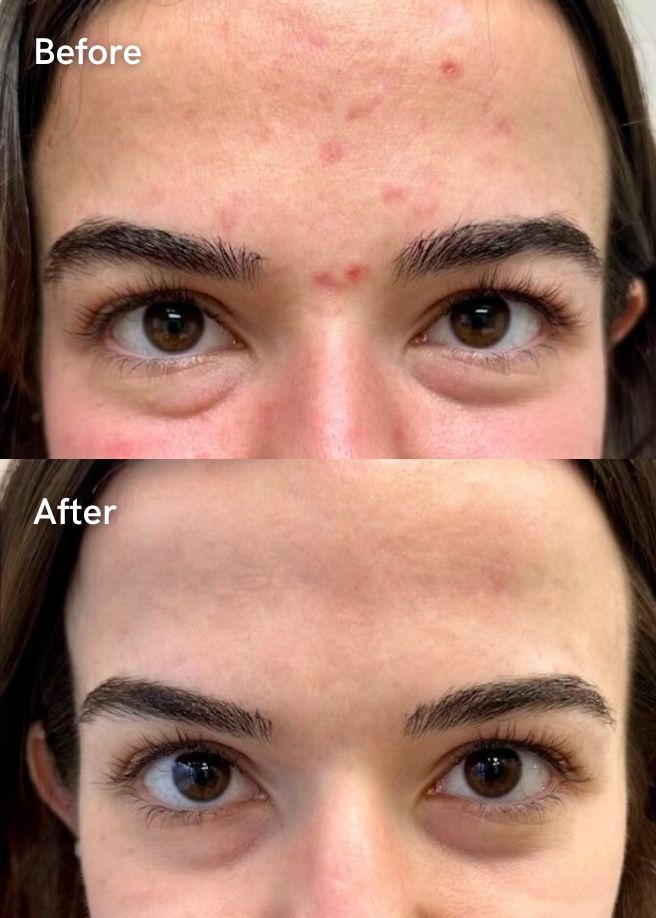 Chemical Peels results