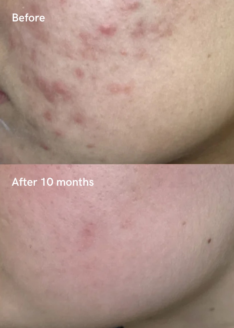 PRP Therapy results
