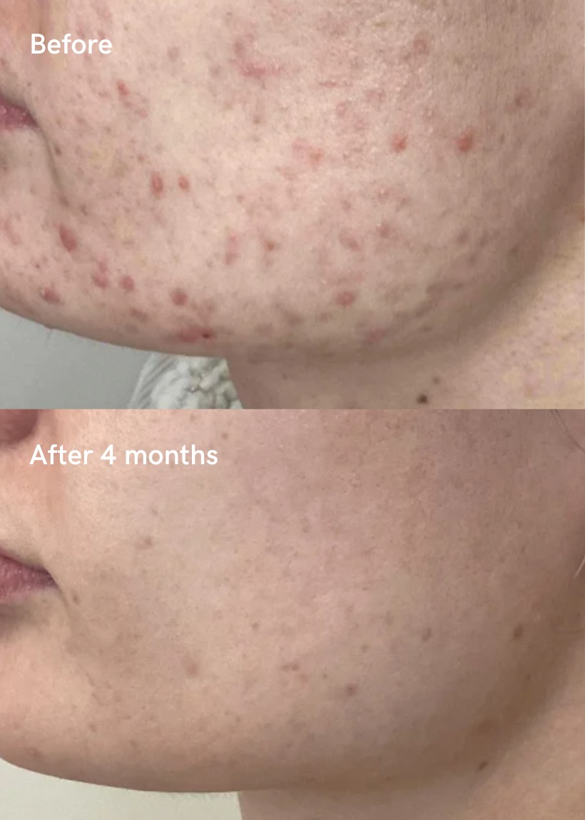 RF Microneedling results