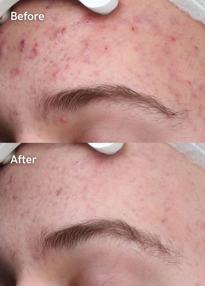 Laser Skin Treatments results