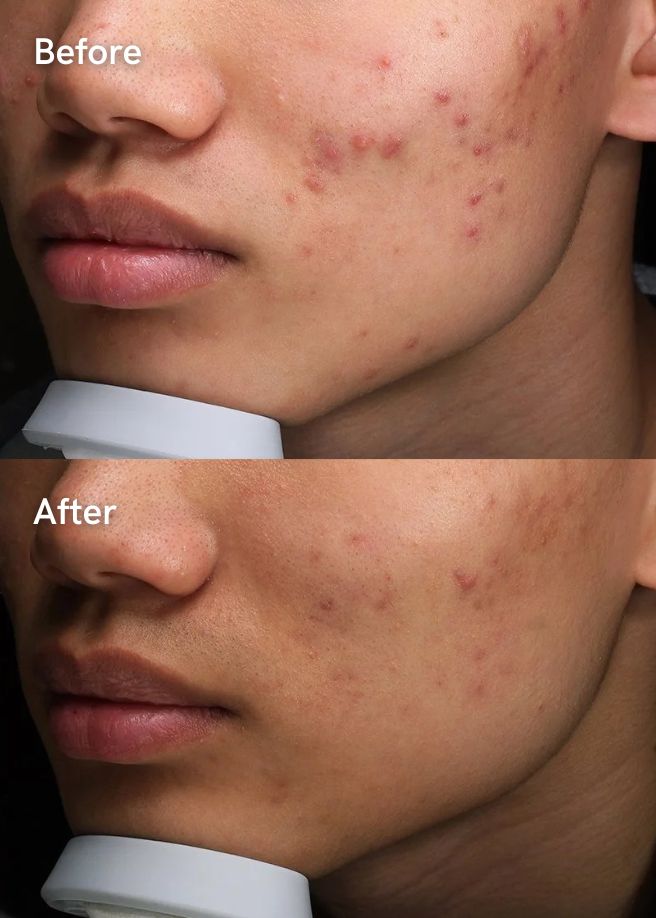 IPL Photofacial results