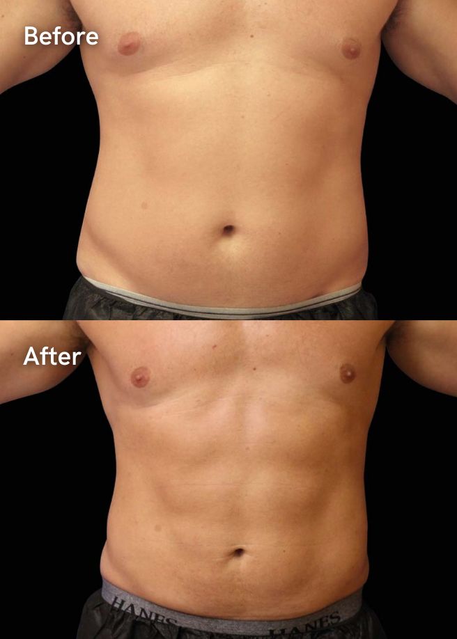 Body Contouring results