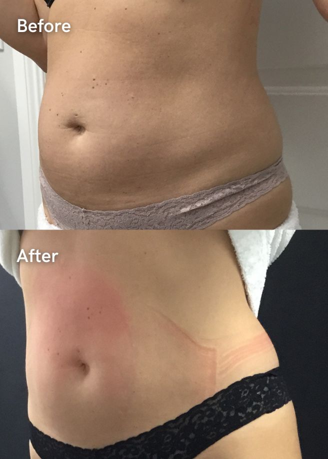 Body Contouring results