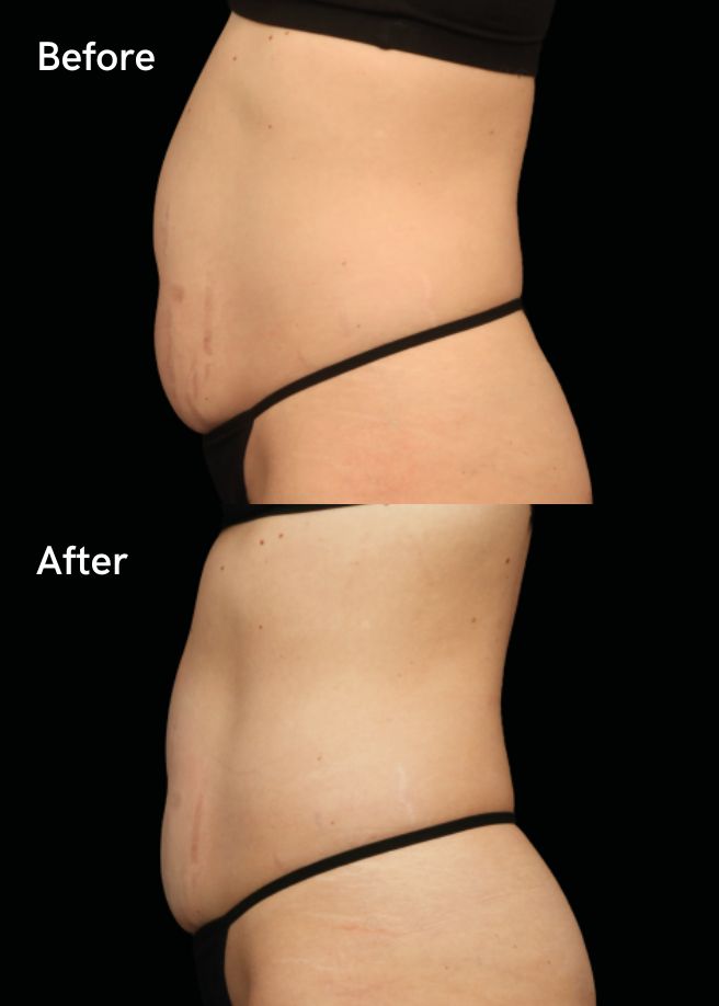 Body Contouring results