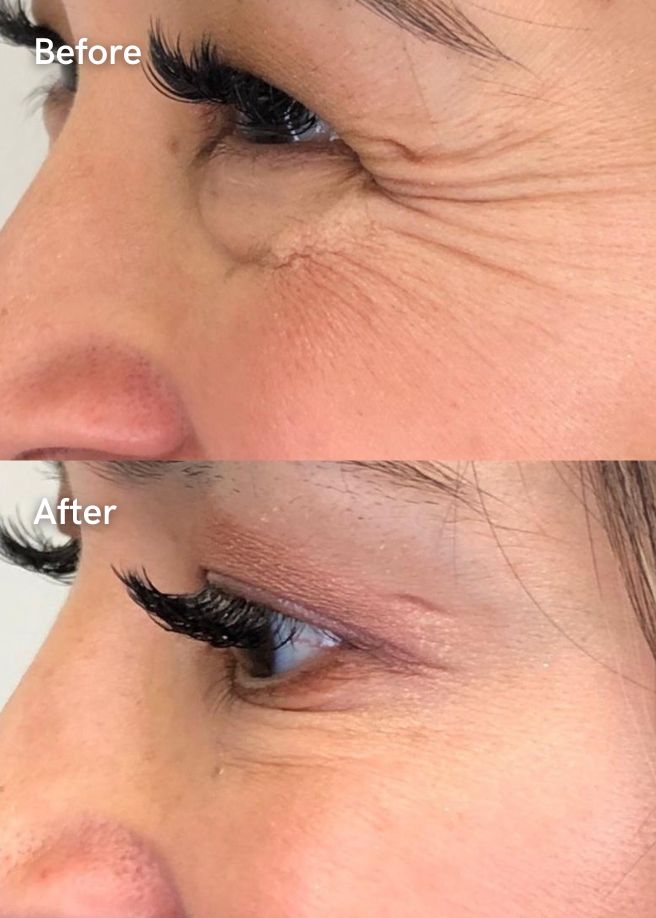Anti-Wrinkle Injections results