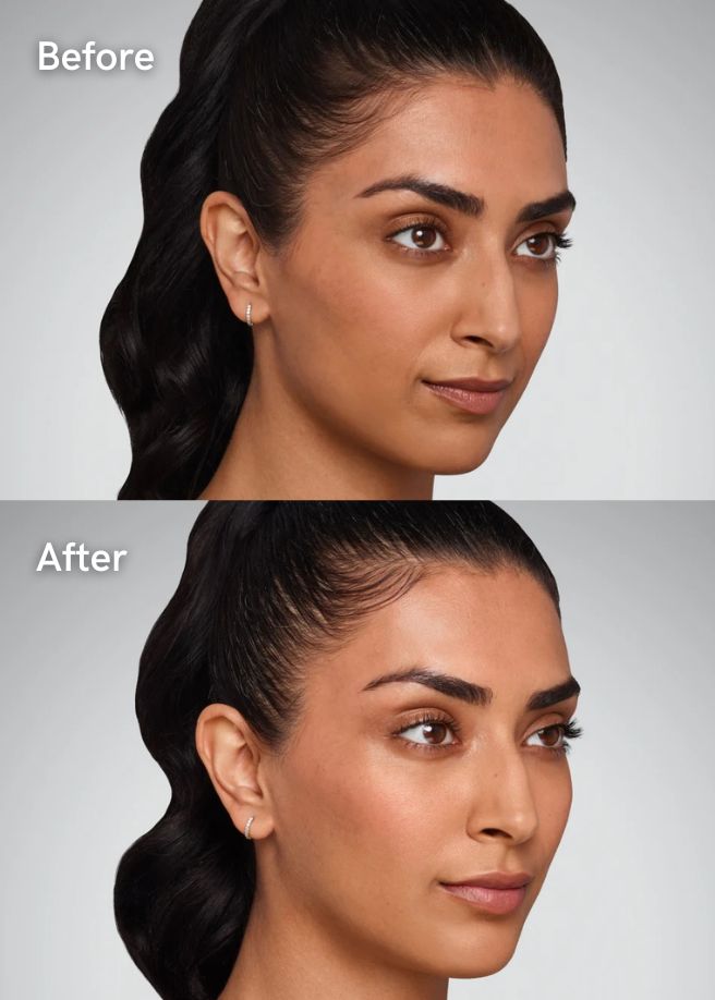 Dermal Fillers results