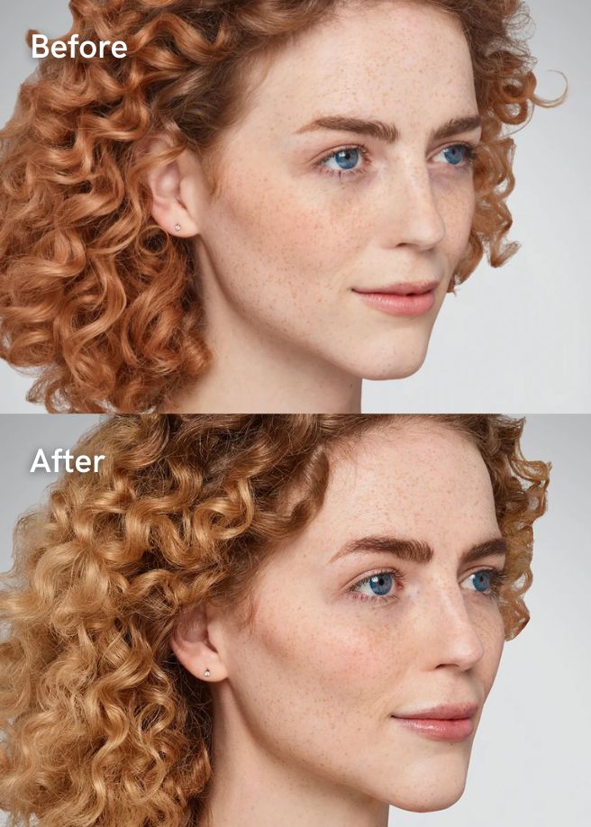 Dermal Fillers results