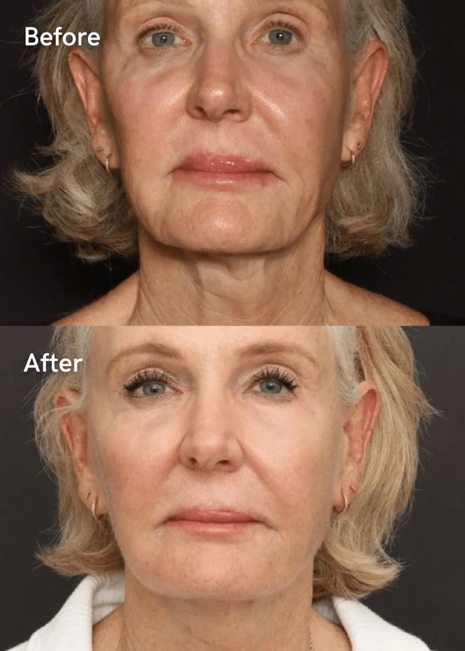 Dermal Fillers results