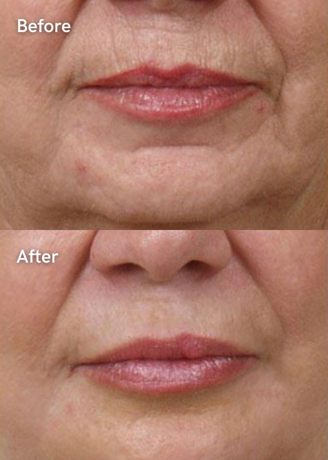 Anti-Wrinkle Injections results