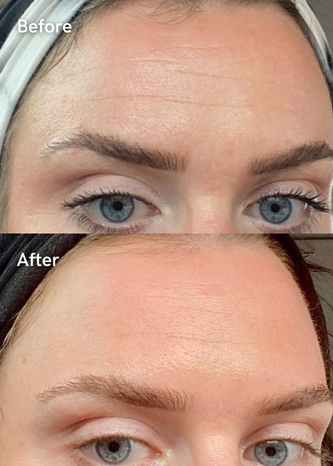 Anti-Wrinkle Injections results
