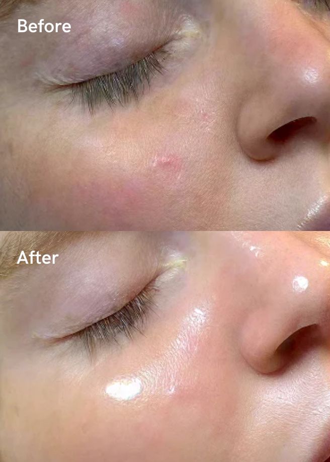 Collagen Stimulator results