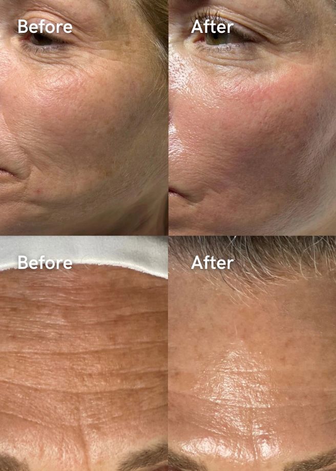 Collagen Stimulator results