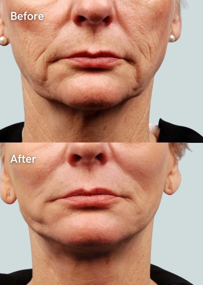 Ultrasound Skin Lifting results
