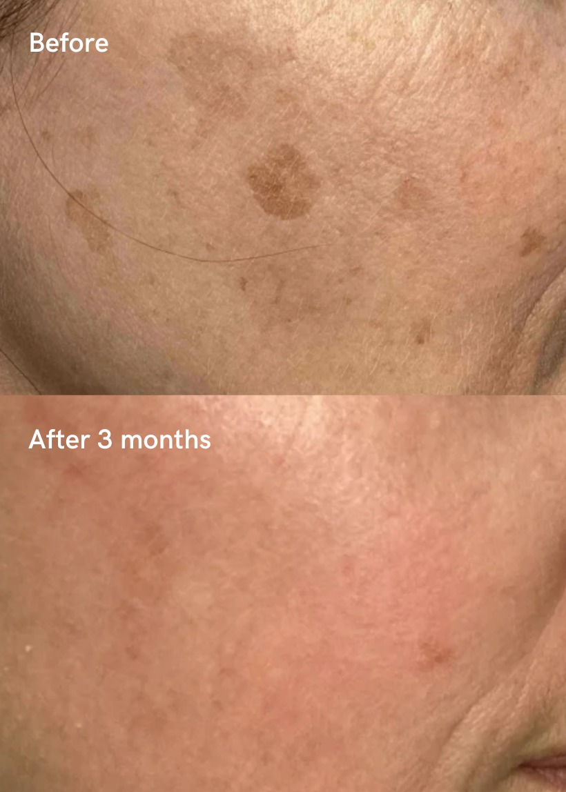 Chemical Peels results