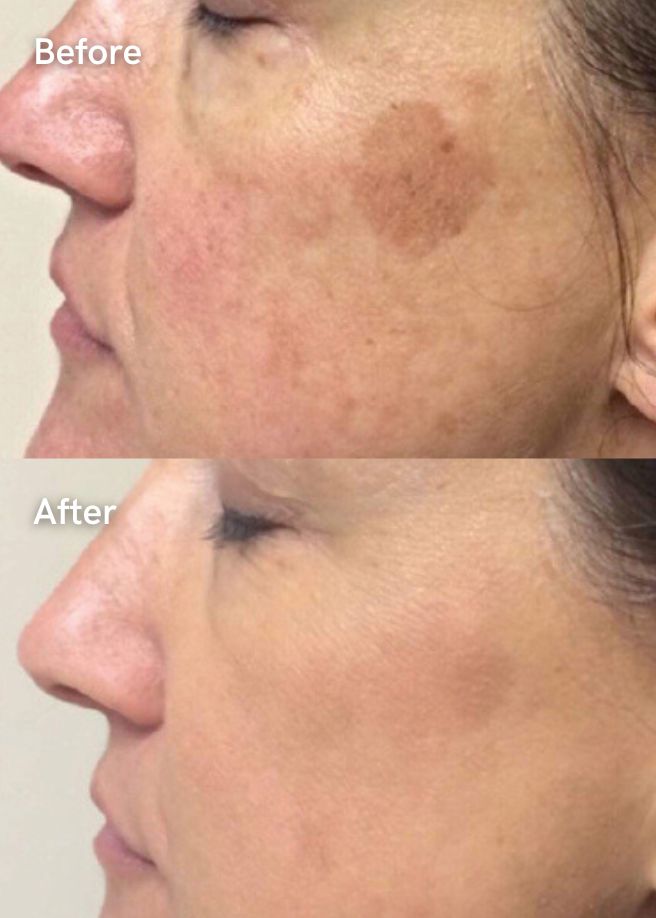 Chemical Peels results