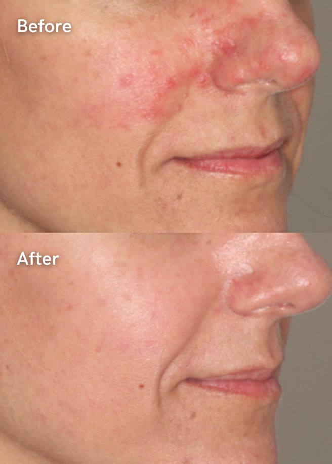 IPL Photofacial results
