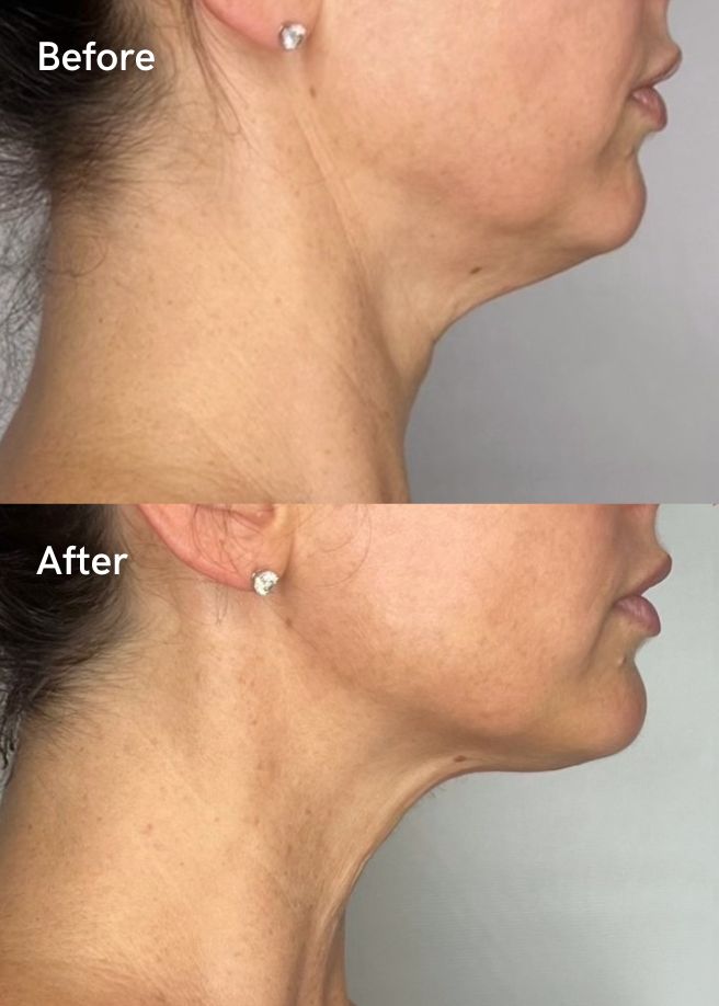 Ultrasound Skin Lifting results