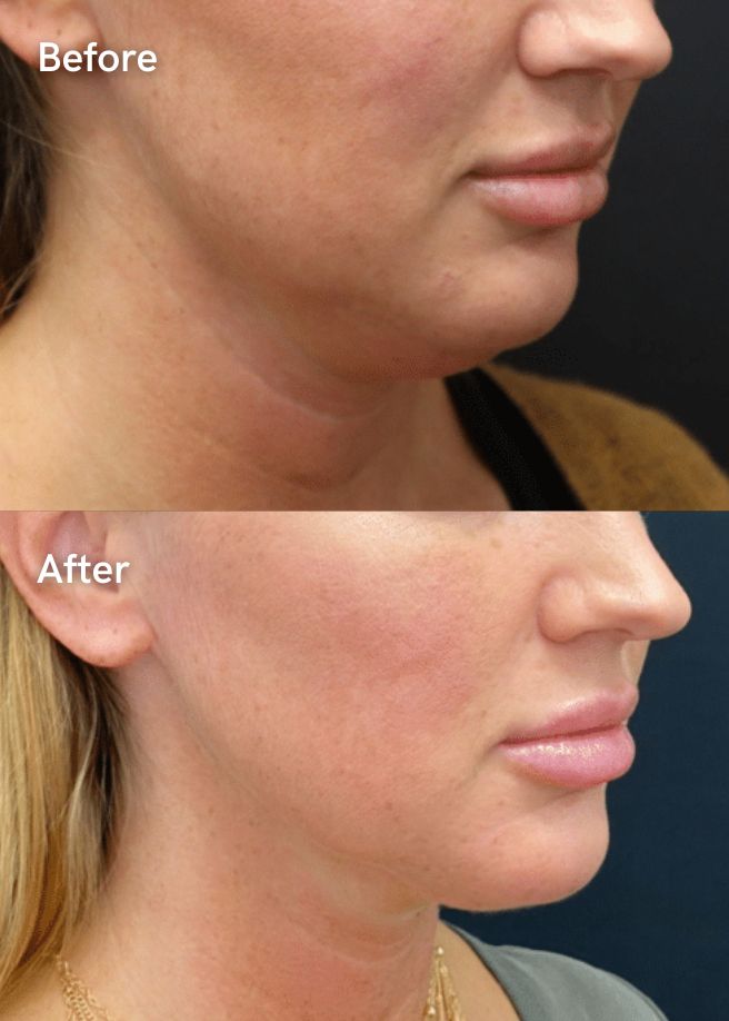 Ultrasound Skin Lifting results