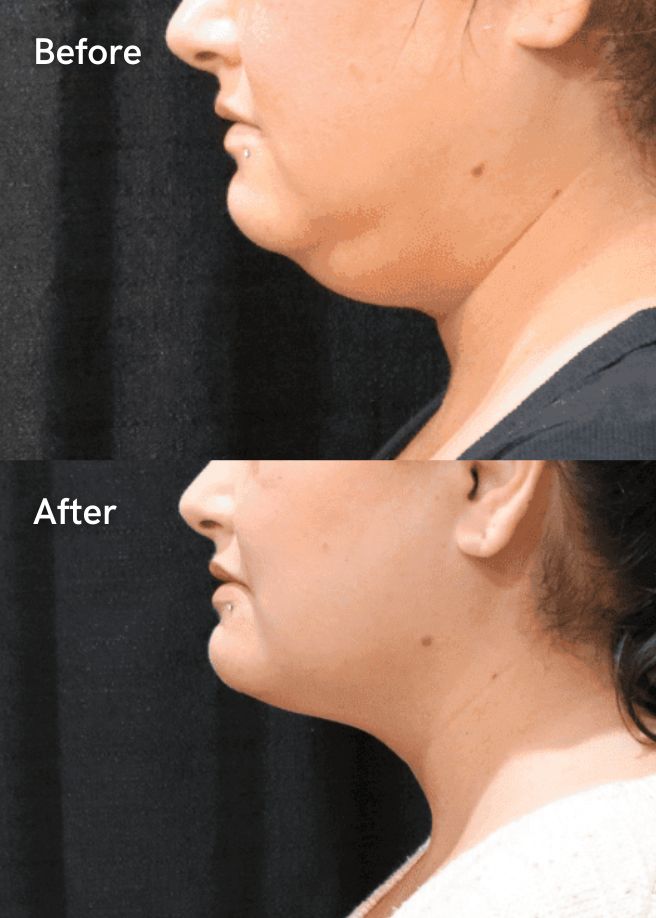 Radiofrequency Skin Tightening results