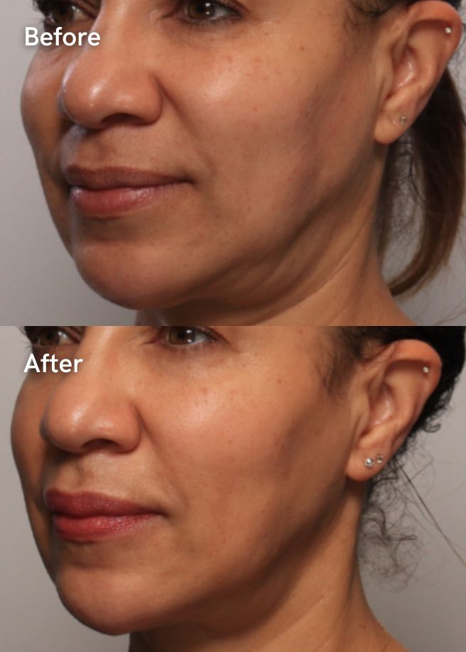 Radiofrequency Skin Tightening results