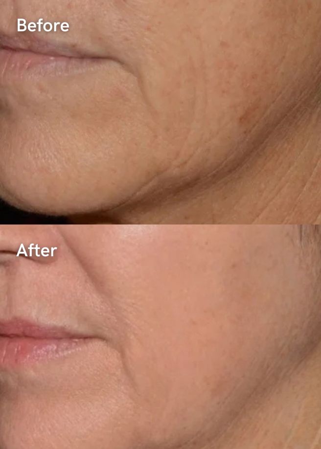 Collagen Stimulator results
