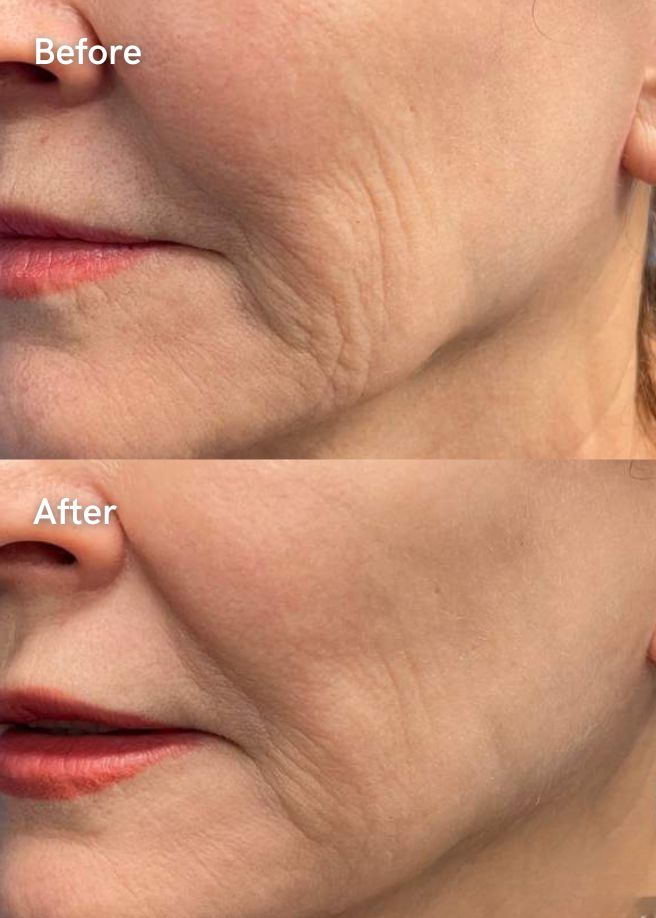 RF Microneedling results